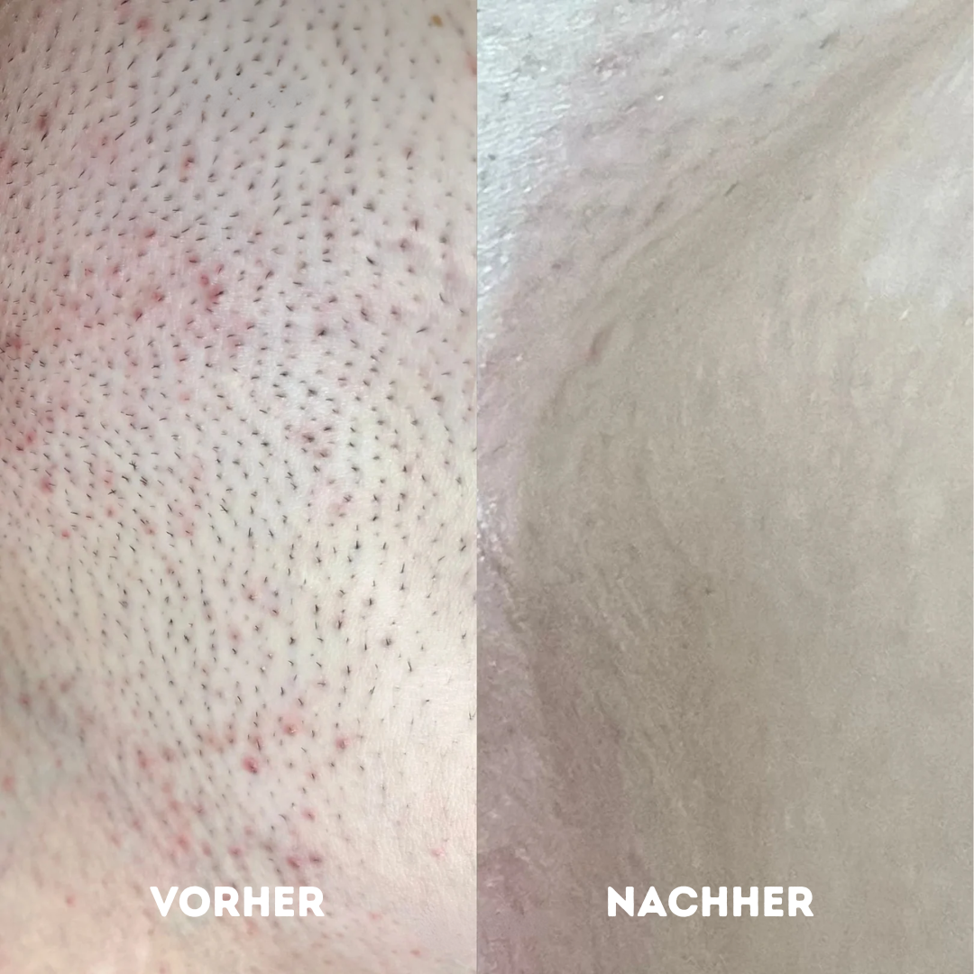 GlowR Hobel Set® für gesunde und glatte Haut