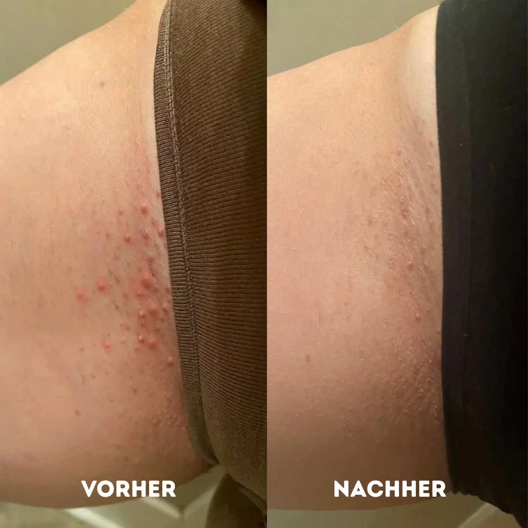 GlowR Hobel Set® für gesunde und glatte Haut