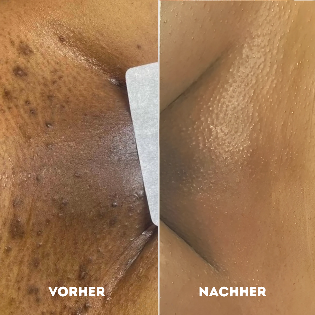 GlowR Hobel Set® für gesunde und glatte Haut