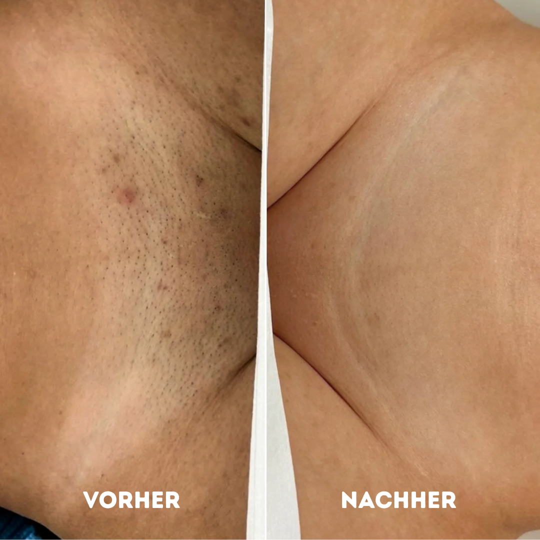 GlowR Hobel Set® für gesunde und glatte Haut